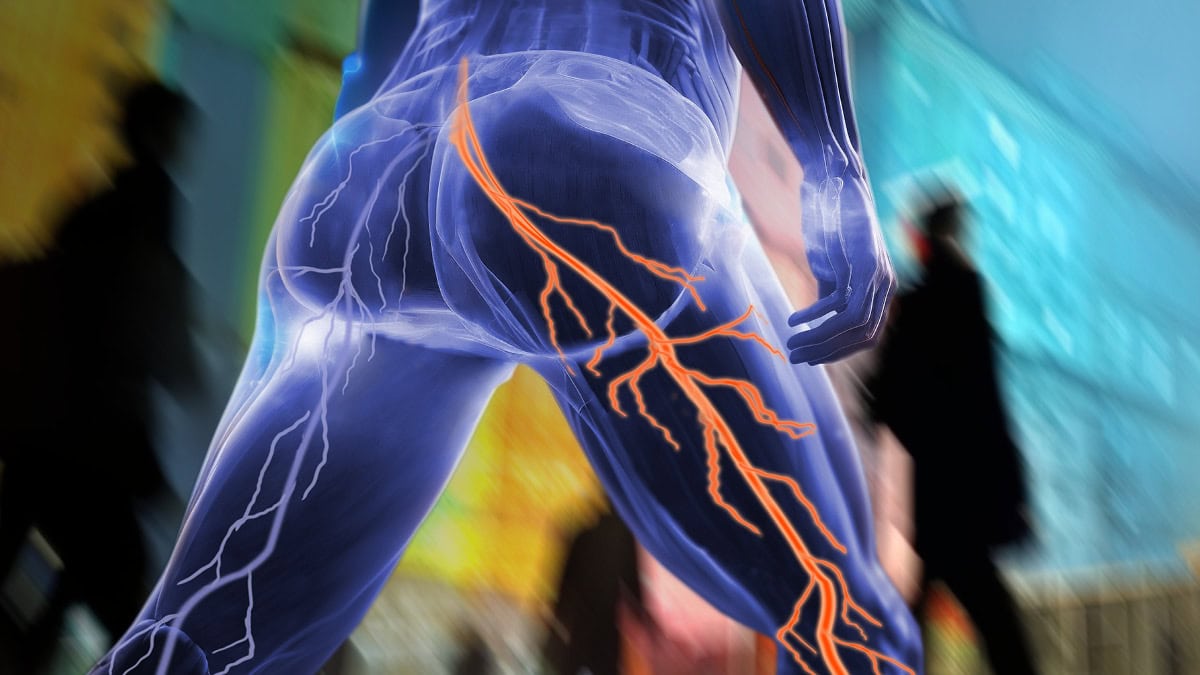 250225 rt de adv ischias v001 fi2